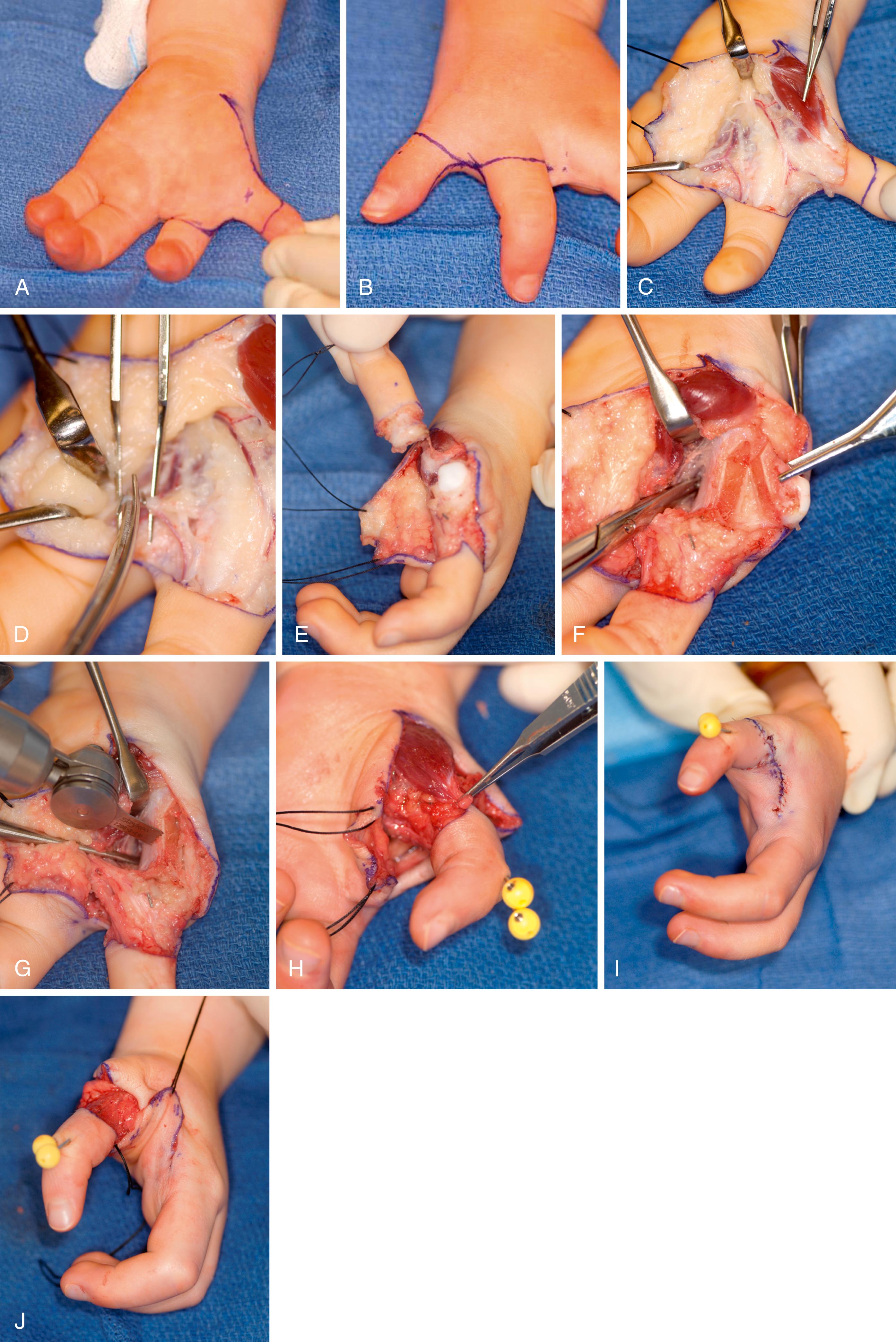 eFig. 37.5, A and B, Incision. C and D, Neurovascular isolation. E and F, Thumb ablation. G–J, Bony resection and abductor reconstruction.