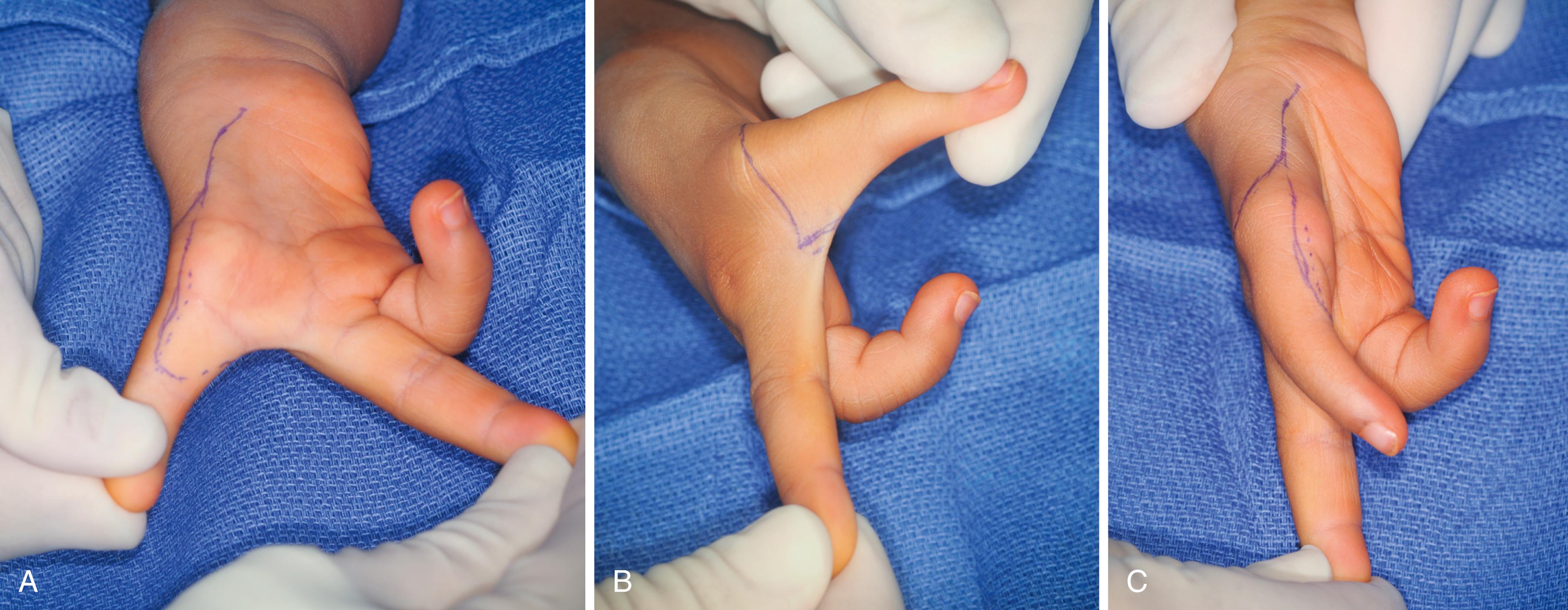 Fig. 37.16, A 4-year-old with absent thumb and ulnar deficiency. A, Volar skin incision that allows more glabrous skin to be placed along the palmar aspect of the index finger. B, Dorsal incision design. C, Radial incision for access to the thumb metacarpal base.