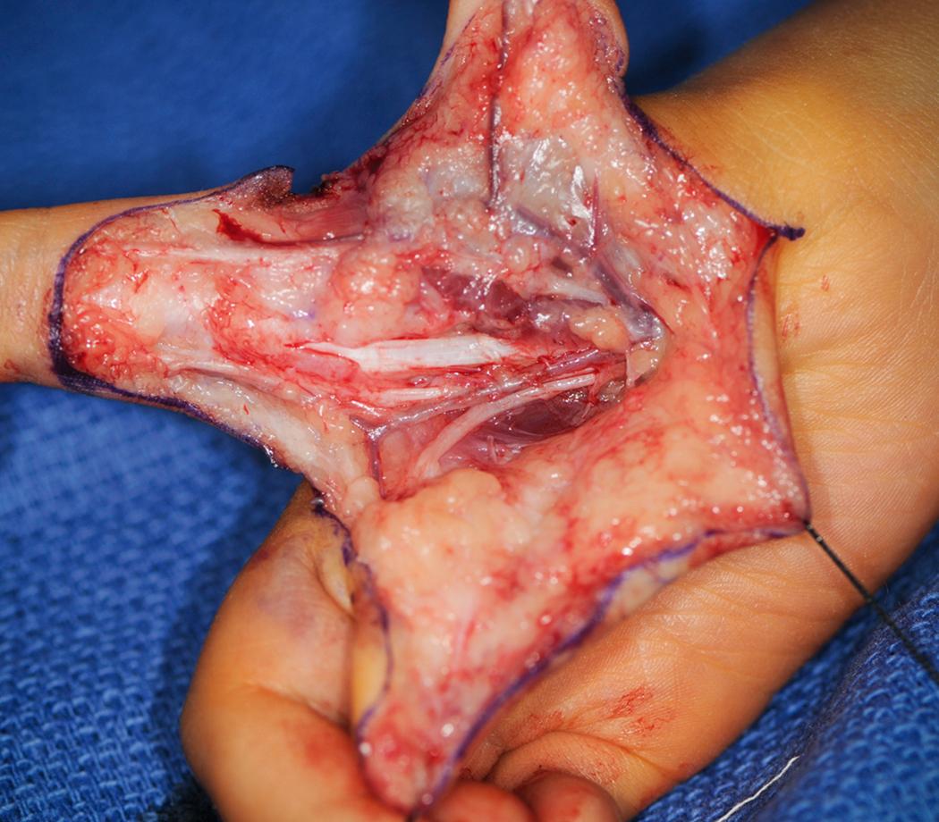 Fig. 37.17, In this child with type IIIB thumb hypoplasia, the single vessel to the hypoplastic thumb was traced to the radial neurovascular bundle of the index finger to ease identification.