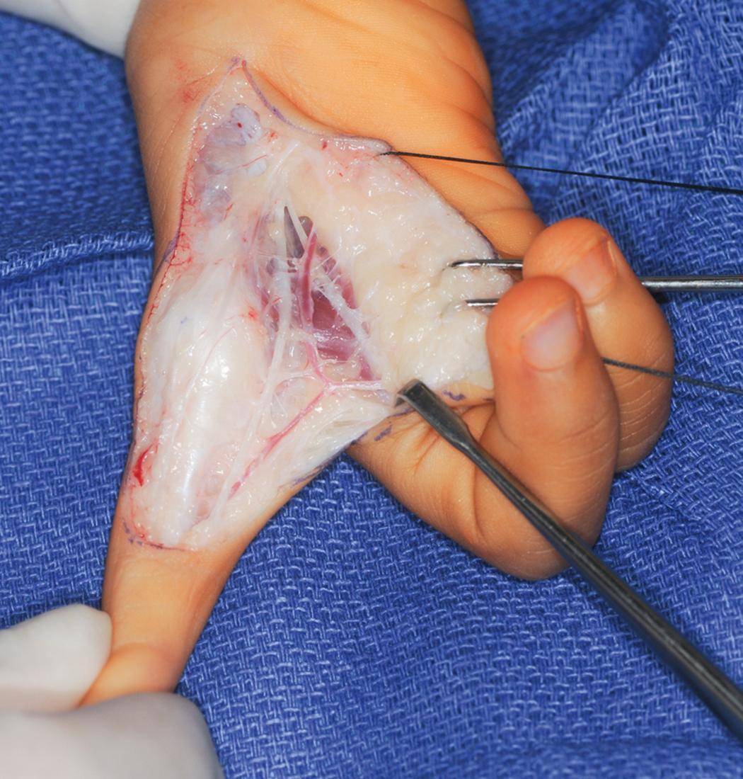 Fig. 37.18, Ulnar dissection to identify the common digital vessels to the index finger/long finger web space.