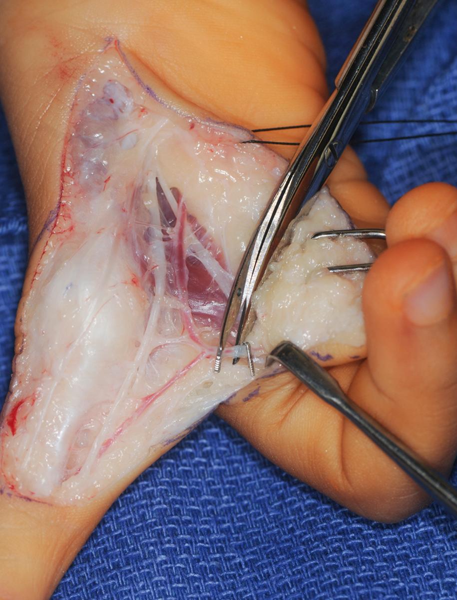 Fig. 37.19, Ligation of the proper digital artery to the long finger with ligature clips.