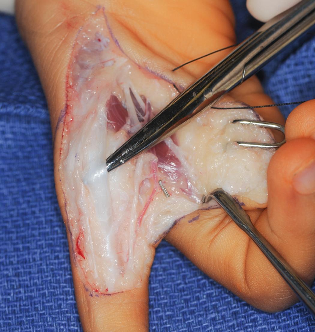 Fig. 37.20, Incision of the first annular pulley to prevent buckling of the flexor tendons after index finger shortening.