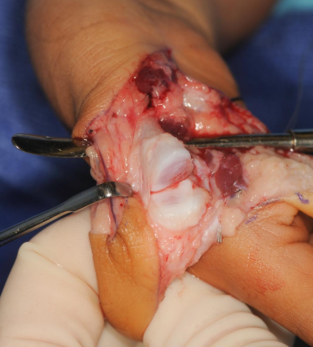 Fig. 37.24, Distal metacarpal cut directly through the physis.