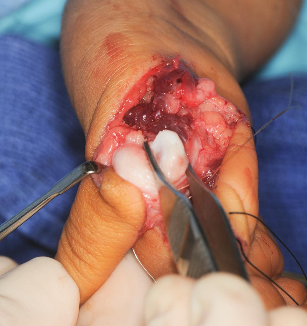 Fig. 37.28, The index metacarpophalangeal joint is fixed into hyperextension, placing the remaining metacarpal head into flexion.