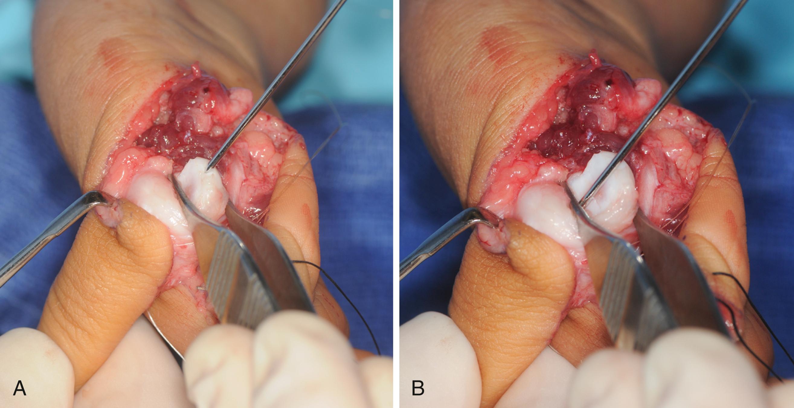 Fig. 37.29, Antegrade Kirschner wire placement. A, Through the metacarpal epiphysis. B, Through the base of the proximal phalanx.