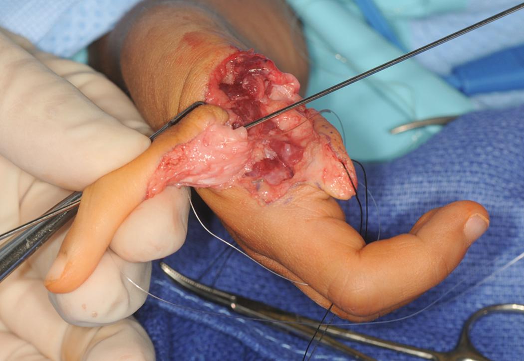 Fig. 37.30, Kirschner wire drilled through the proximal phalanx and out the proximal interphalangeal joint.