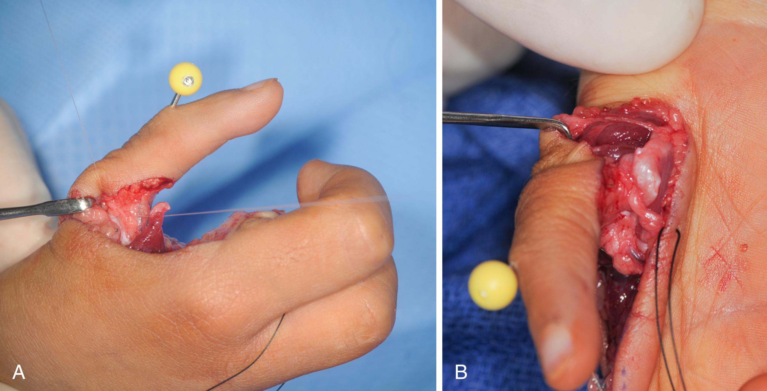 Fig. 37.33, Tendon transfer to restore intrinsic function to the thumb. A, First palmar interosseous to the ulnar lateral band about the proximal interphalangeal joint. B, First dorsal interosseous to the radial lateral band.