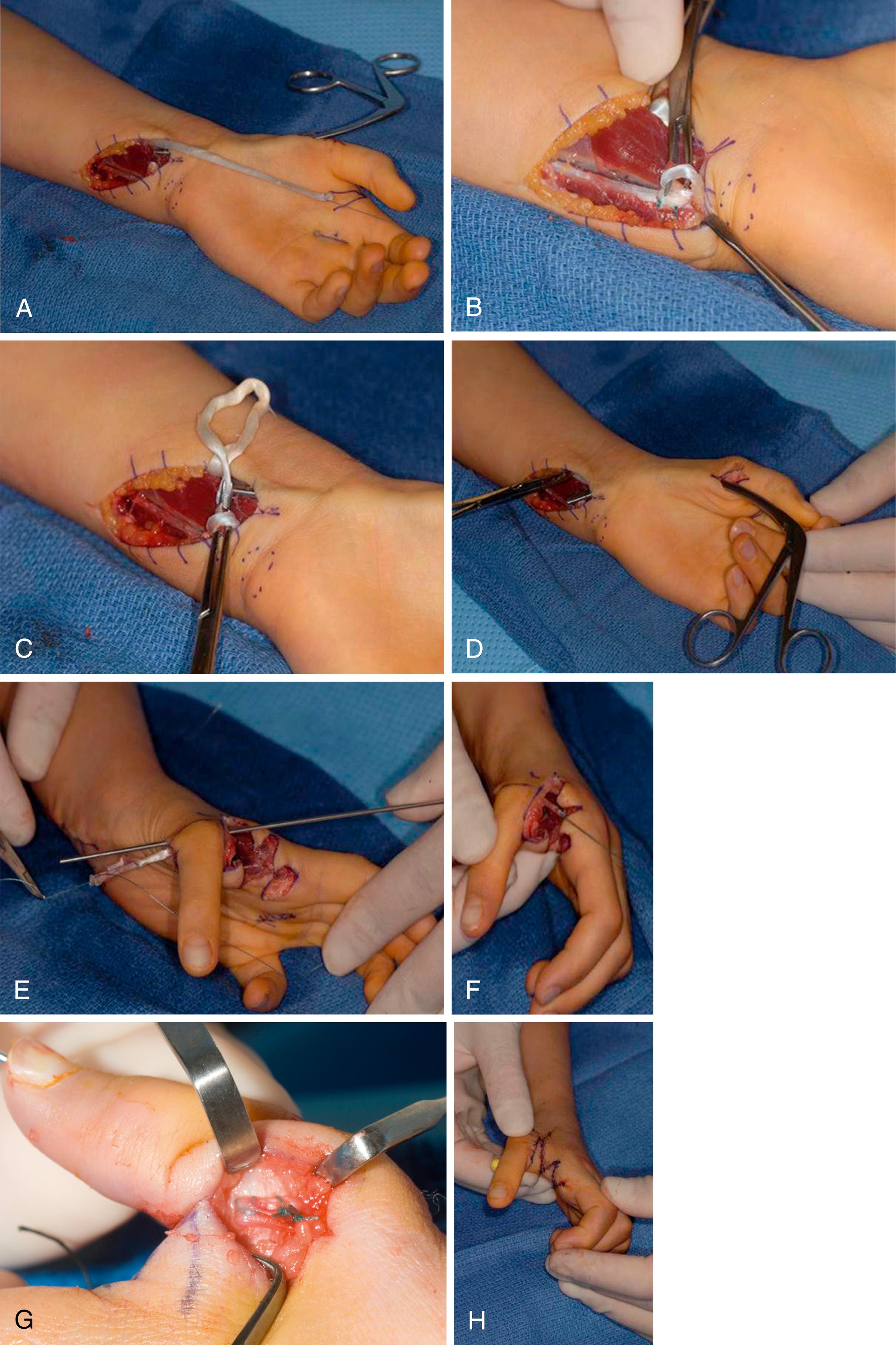 eFig. 37.2, Surgical technique. A, Flexor digitorum superficialis (FDS) harvest. B, Flexor carpi ulnaris pulley. C, FDS through pulley. D, FDS through subcutaneous tunnel. E, FDS through metacarpal head. F, FDS along ulnar metacarpophalangeal joint. G, Ulnar collateral ligament reconstruction. H, Pinning and four-flap Z-plasty closure.