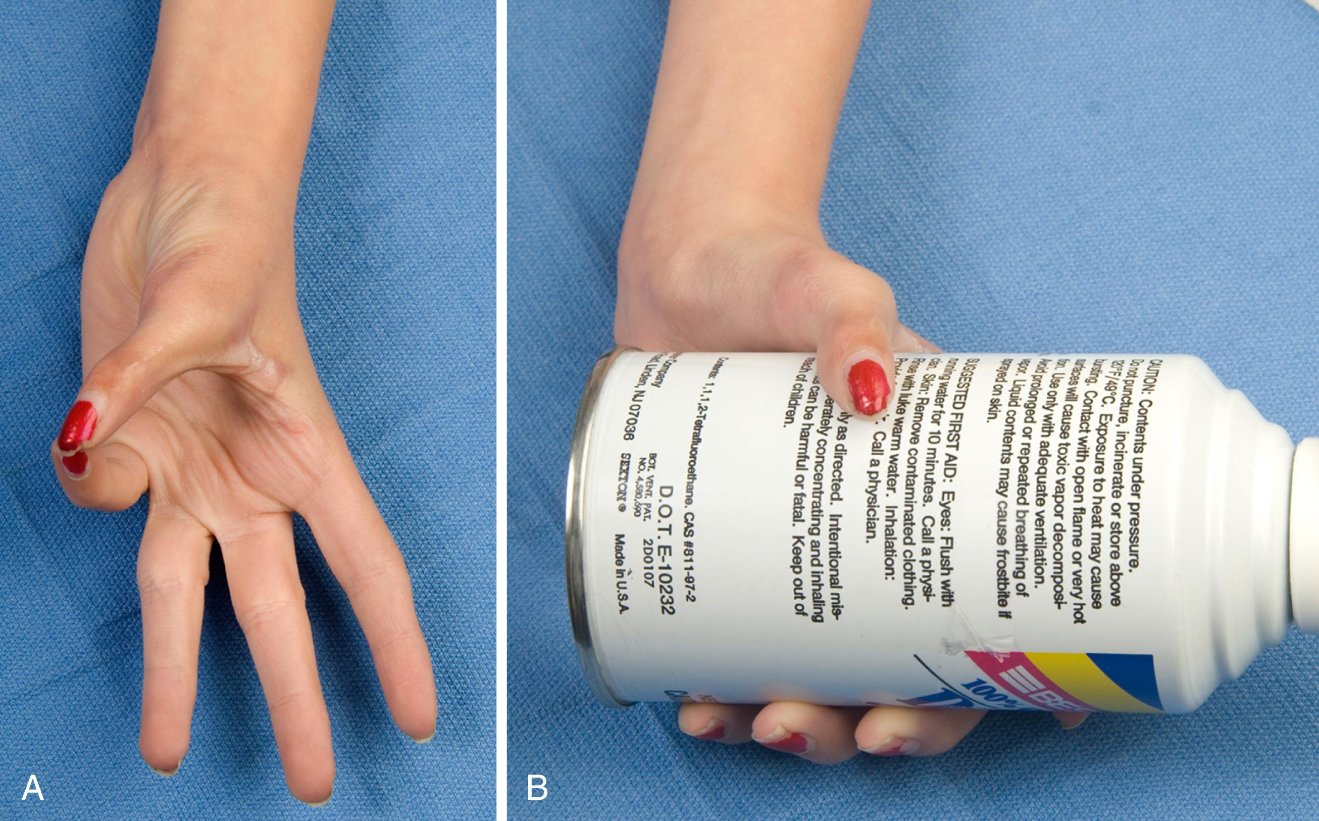 Fig. 37.36, A 10-year-old child following left flexor digitorum superficialis tendon opposition transfer. A, Excellent opposition to the small finger. B, Improved ability to acquire large objects.