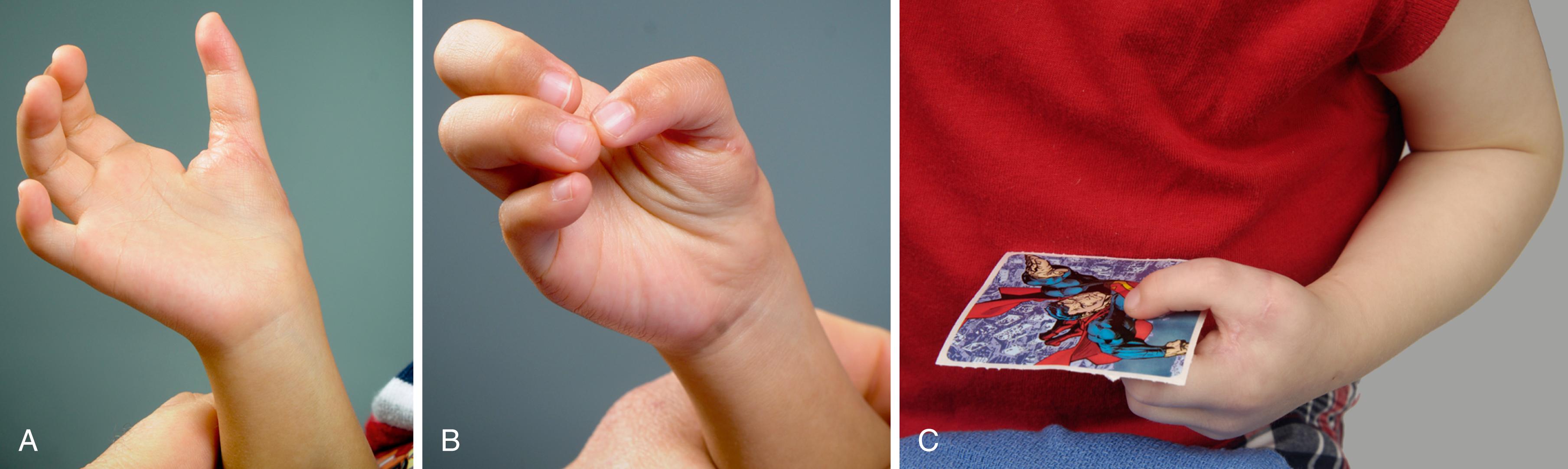 Fig. 37.37, A 3-year-old following index finger pollicization. A, Overall appearance. B, Movement pattern. C, Pinching a sticker.