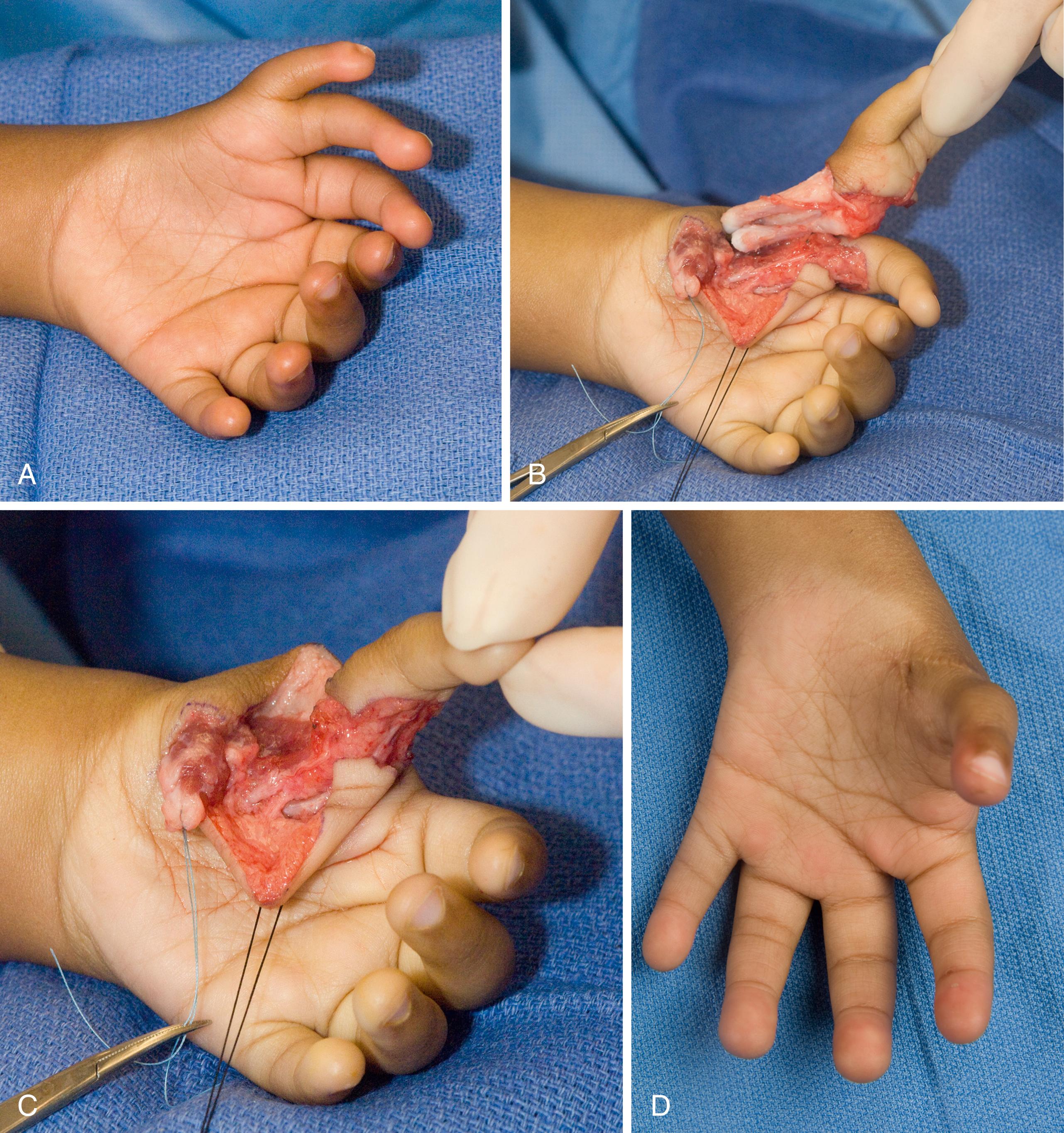 Fig. 37.38, A 3-year-old girl with mirror hand and seven fingers. A, Clinical appearance. B, Ablation of the two less mobile radial digits. C, Pollicization of the most mobile radial digit. D, Appearance after pollicization.