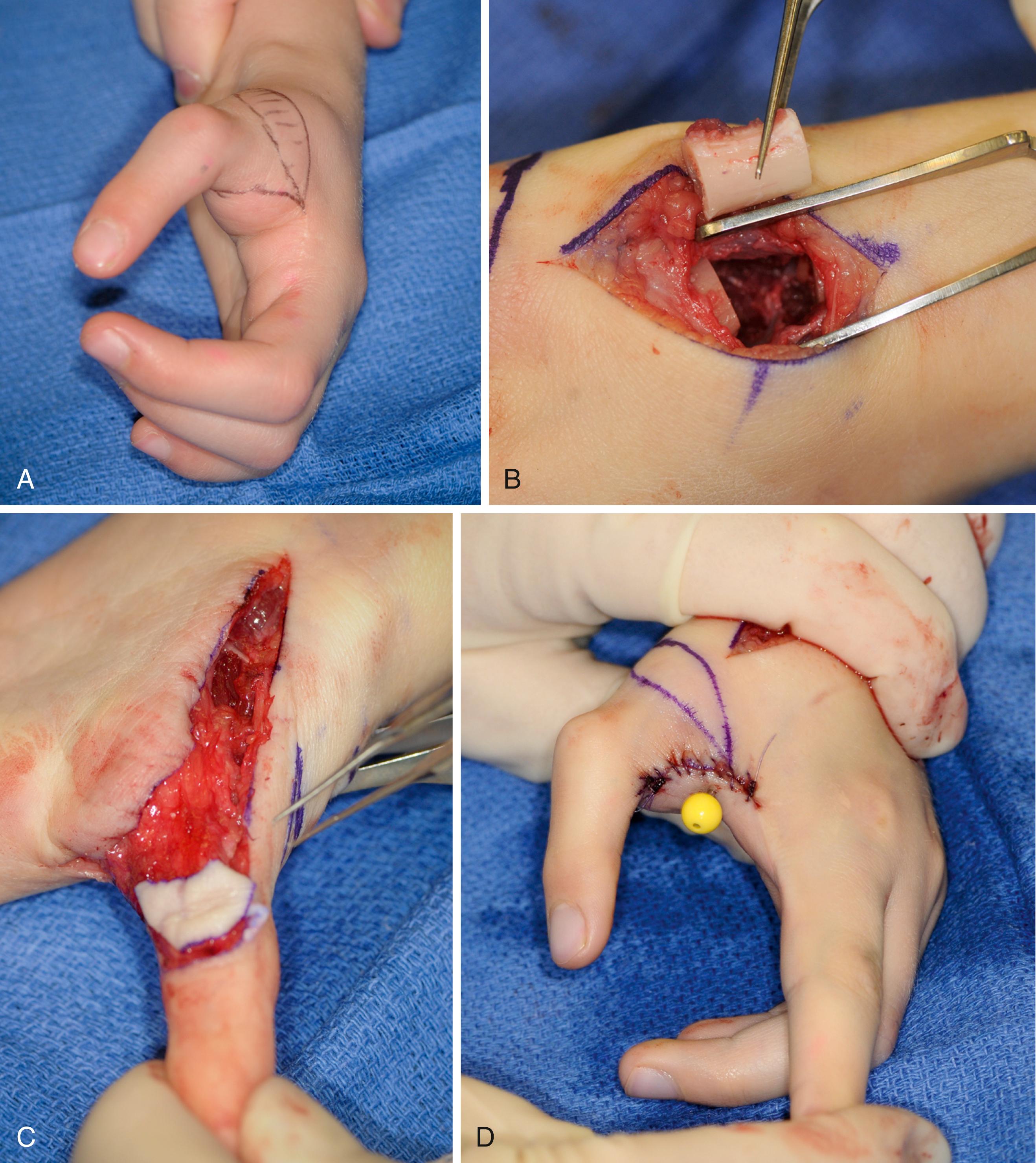 Fig. 37.40, A 6-year-old with a long thumb attributed to ongoing growth at the metacarpal physis. A, Clinical appearance of elongated thumb. B, Bony resection and epiphysiodesis. C, Skin reduction. D, Final appearance.