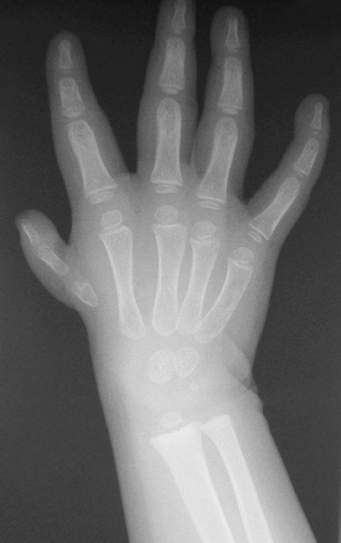 Fig. 37.3, Radiograph of a 2-year-old revealing a thumb metacarpal that tapers to a point, indicative of an unstable carpometacarpal joint.