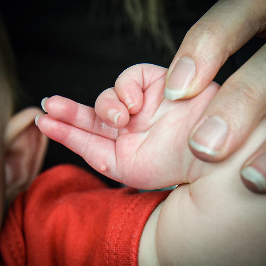 Fig. 37.5, A 1-year-old with type V thumb hypoplasia, and a small skin nubbin present in complete absence of the thumb.