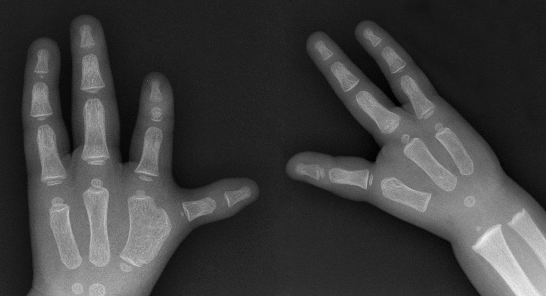 Fig. 37.6, Radiograph of a 4-year-old with bilateral ulnar deficiency and marked left thumb hypoplasia.