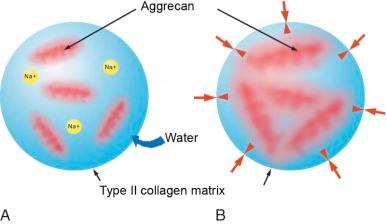 eFIGURE 47–2, Cartilage swelling pressure. Large molecules of aggregating proteoglycans (aggrecan) are imbedded within the fibrils of the type II collagen matrix. When aggrecan is hydrated, the high density of negative charges draws in sodium and water, causing the aggrecan molecule to swell. Aggrecan swelling is restrained by the surrounding collagen fibrils, resulting in a large interstitial swelling pressure responsible for the compressive stiffness of cartilage. In early cartilage damage, fragmentation of the collagen matrix allows unrestrained swelling of aggrecan and lowers the internal pressure of cartilage. This makes the cartilage more compressible and susceptible to further degeneration.