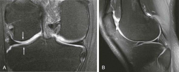 eFIGURE 47–3, A , Coronal, 3 T, fat-suppressed, PD-weighted, TSE MR image of the knee illustrating normal spatial variation in cartilage signal intensity. Areas chronically exposed to high compressive loads, such as the uncovered cartilage of the medial compartment (arrows) , demonstrate a striated hypointense signal intensity of the radial zone, with a thin hyperintense superficial zone. This is a result of the high type II collagen content of the radial zone that has an anisotropic orientation perpendicular to the bone-cartilage interface. The hyperintense superficial zone is thicker in regions of the joint with less compressive load. B , Sagittal, 3 T, fat-suppressed, PD-weighted, TSE MR image of the knee illustrating uniformly high cartilage signal intensity in the trochlea and posterior femoral condyle. There is a striated appearance of the central load-bearing regions of the femoral condyle and tibial plateau. PD , Proton density; T , tesla; TSE , turbo spin-echo.