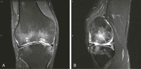 FIGURE 47–1, A , Coronal, fat-suppressed, PD-weighted, FSE MR image of a 27-year-old man with Stickler syndrome, an inherited point mutation of the type II collagen gene. Extensive cartilage loss is present in the medial compartment with associated degenerative changes in the subchondral bone. Although there is normal thickness of cartilage in the lateral compartment, there is a loss of spatial variation in signal intensity observed in normal cartilage. B , Sagittal, fat-suppressed, T2-weighted MR image of same patient as in A . There is linear hyperintensity at the bone-cartilage interface compatible with cartilage delamination (arrow). FSE , Fast spin-echo; PD , proton density.