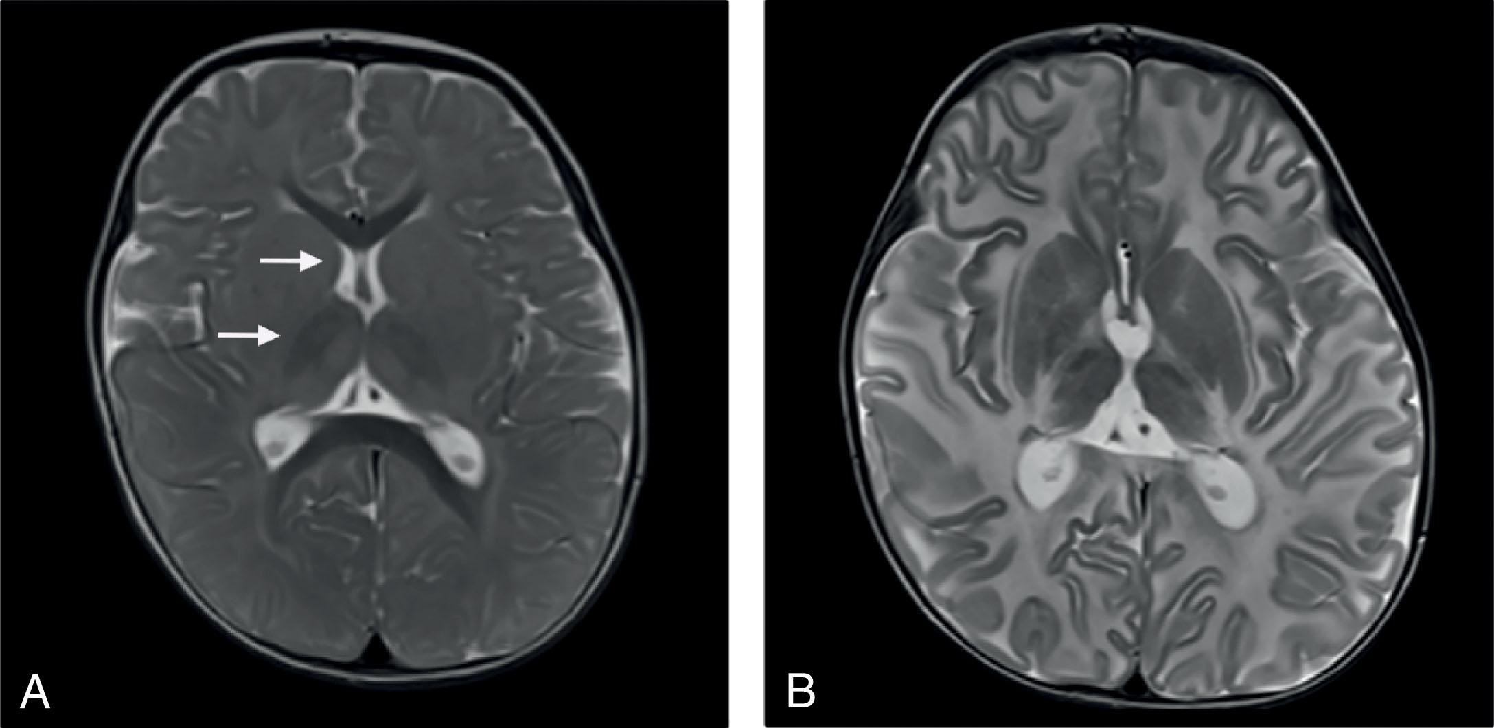 Fig. 33.2, Tay-Sachs disease: MRI. Axial T2-weighted images of an infant with developmental regression at 6 months of age found to harbor a pathogenic variant in the HEXA gene. (A) T2-weighed hypointensity is present in the thalamus bilaterally and head of the caudate (arrows) at 14 months of age, progressing to diffusely increased T2-weighted signal in the cerebral white matter by 28 months of age (B).