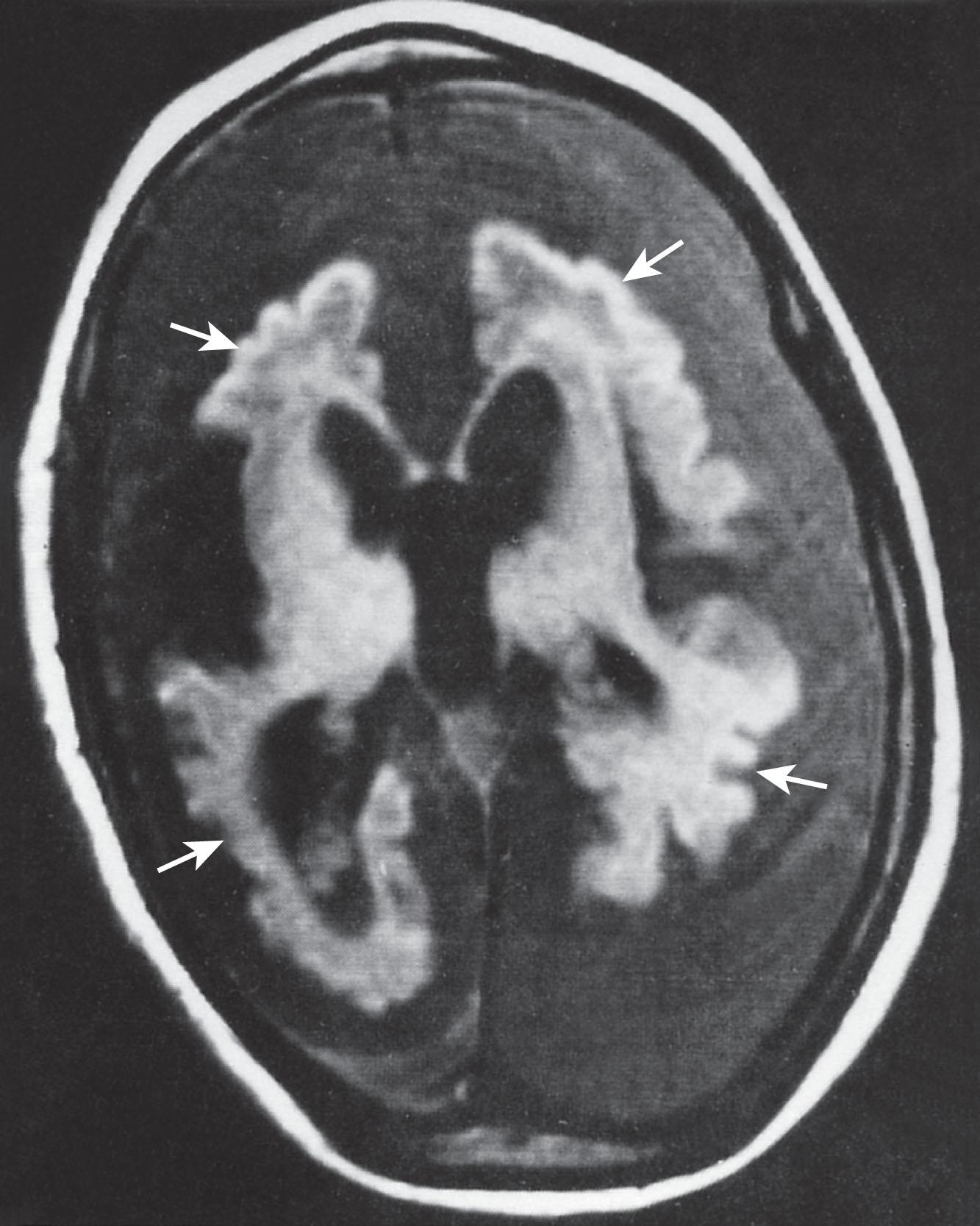 Fig. 33.4, Early infantile neuronal ceroid-lipofuscinosis: MRI scan. This T1-weighted MRI scan, performed at 4 years of age, shows striking cortical atrophy and markedly dilated lateral ventricles, secondary to atrophy. The shriveled cortical surface is marked by arrows ; the low signal intensity surrounding the brain is extracerebral fluid. In congenital neuronal ceroid-lipofuscinosis, the atrophy is present in the first weeks and months of life (see Fig. 33.5 ).