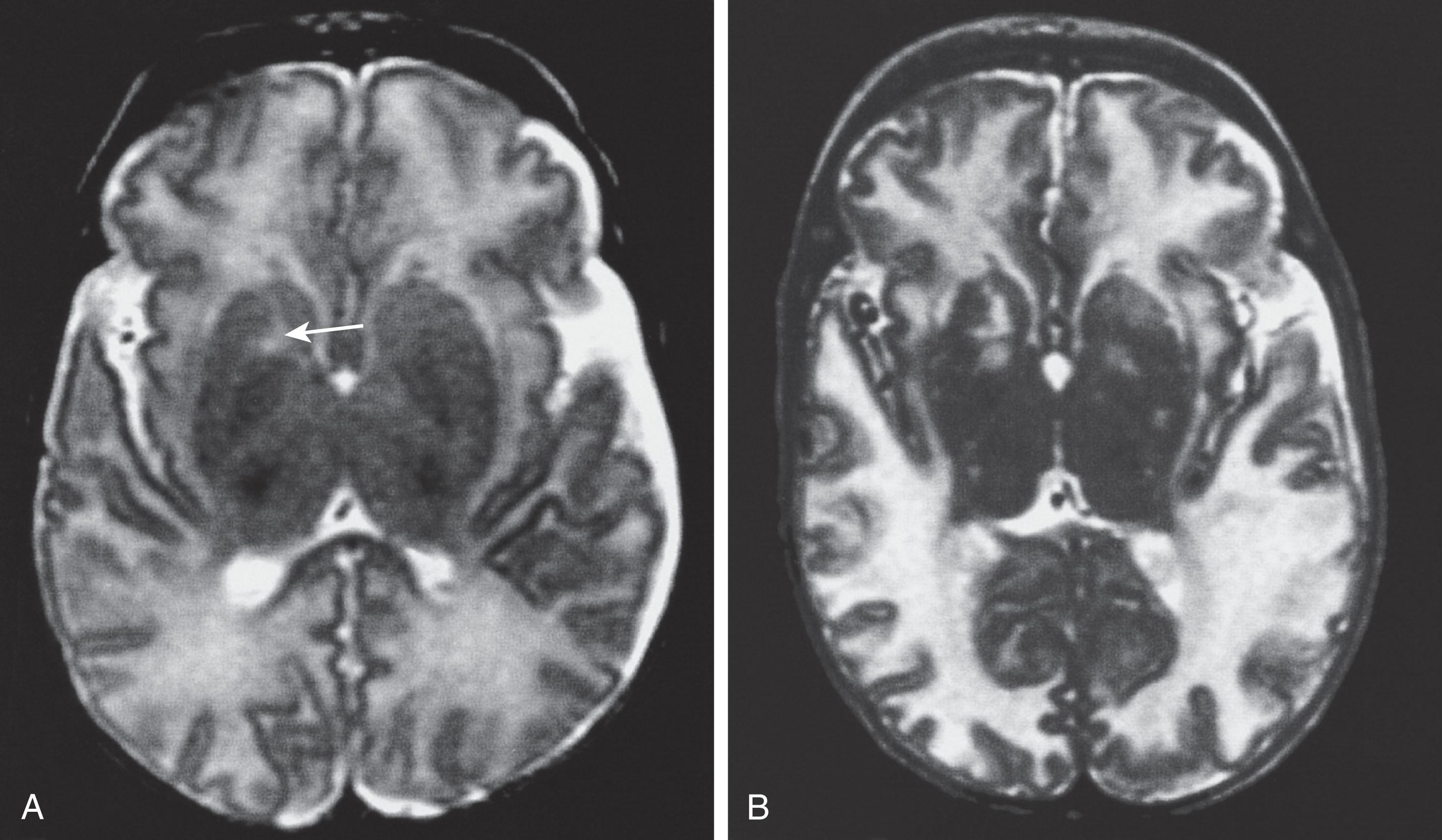 Fig. 33.9, Evolution of cerebral parenchymal changes in Menkes disease, as shown by MRI. The infant presented with severe refractory seizures at 6 weeks of age, after premature delivery at 30 weeks of gestation. (A) Axial T2-weighted MRI at 8 weeks of age shows a moderate degree of cerebral cortical atrophy, a focal area of high signal intensity in the right putamen ( arrow ), and moderately high signal intensity in cerebral white matter. (B) Axial T2-weighted MRI at 14 weeks of age shows marked progression with multiple lesions in the basal ganglia and thalami, more cortical atrophy, and markedly higher signal intensity in cerebral white matter. MR spectroscopy at the time of the second MRI showed markedly elevated lactate and markedly depressed N -acetyl aspartic acid in the basal ganglia and cerebral white matter.