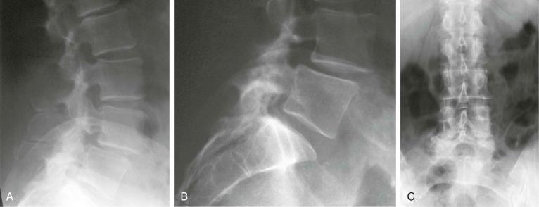 FIGURE 45–1, Radiographs of the lumbar spine. Lateral ( A ) and coned lateral ( B ) views demonstrate narrowing of the L4 to L5 disk space associated with a forward displacement of L4 on L5 as a degenerative spondylolisthesis due to osteoarthritis of the facet joints. C , Anteroposterior radiograph shows sclerosis at the L4 to L5 facet joints and a mild lateral curve.