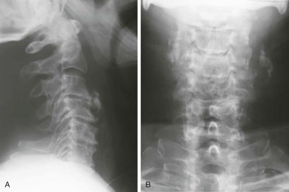 FIGURE 45–2, A , Lateral radiograph of the cervical spine demonstrates multiple narrowed disk spaces with anterior osteophyte formation and a retrolisthesis of C4 on C5. Facet joint space narrowing with some sclerosis is present. B , Anteroposterior view demonstrates osteoarthritic osteophyte proliferation along the lateral margins of the facet joints and narrowing and sclerosis of the neurocentral joints.