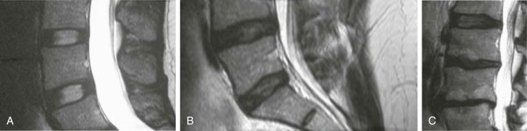 FIGURE 45–3, Sagittal, T2-weighted, fast spin-echo MR images of the intervertebral disk showing the five grades of disk degeneration. A , Grades 1 and 2. B , Grade 3. C , Grades 4 and 5 (see also Table 45-1 ).