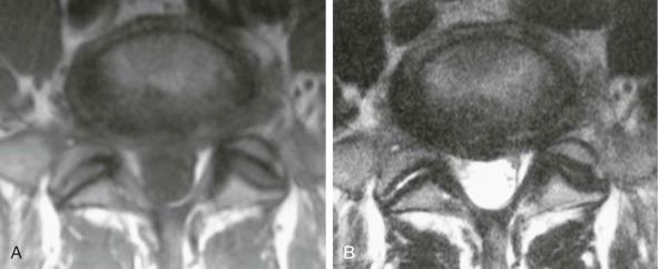 FIGURE 45–4, Disk bulge. Axial T1-weighted ( A ) and T2-weighted ( B ) fast spin-echo MR images demonstrate the disk extending circumferentially beyond the outline of the vertebral body.