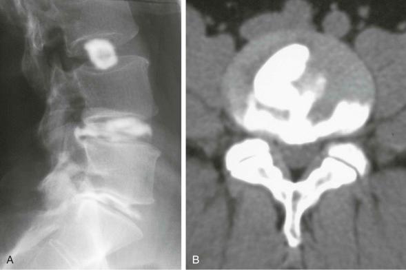 eFIGURE 45–1, Disk degeneration. A , Three-level discogram shows a normal delineation of the nucleus at L3 to L4, degeneration with circumferential posterior annular disruption at L4 to L5, and marked degeneration at L5 to S1. B , CT discography demonstrates that the contrast medium injected into the nucleus has extended through the posterior annular fibers and circumferentially between the fibers.