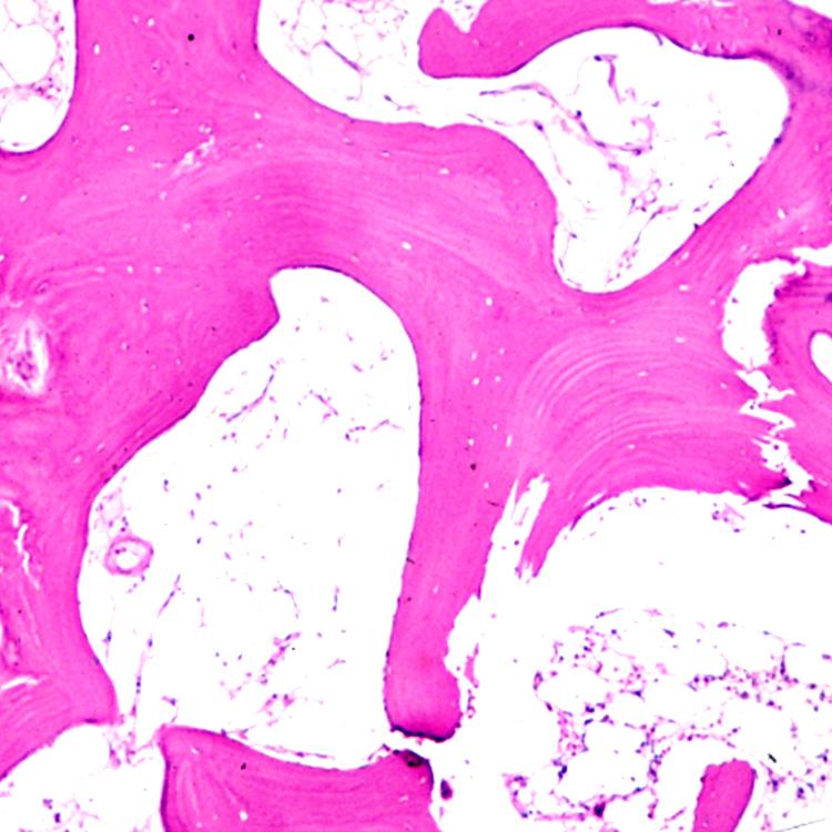 Micropathology, low-power H&E shows type II changes with fatty replacement of normal hematopoietic marrow. Note the thickened trabeculae with new woven bone formation.