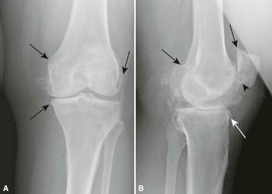 Figure 19-1, Osteoarthritis. Anteroposterior ( A ) and lateral ( B ) views of the knee showing severe medial compartmental narrowing and mild subchondral sclerosis. There is tricompartmental osteophytic lipping ( arrows ). Intra-articular loose bodies are readily seen. A subchondral cyst in the inferior aspect of patella can be seen ( B, arrowhead ).