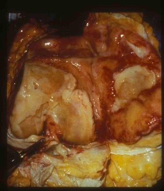 Figure 19-3, Osteoarthritis. Gross photograph of a knee joint showing erosion and cracking of articular surface with denudation and exposure of underlying bone.