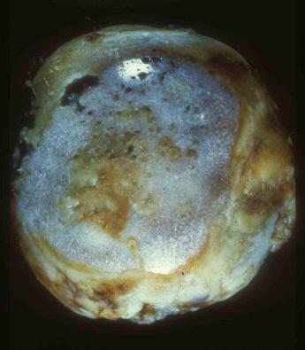 Figure 19-4, Osteoarthritis. Gross photograph of a femoral head showing erosion and cracking of articular surface with denudation and exposure of underlying bone.