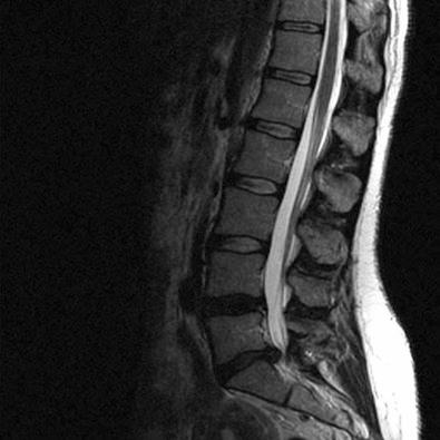 Figure 36.2, Single-level disk herniation in the cervical and lumbar spine.