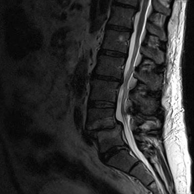 Figure 36.3, Sagittal MRI of the lumbar spine showing a grade I spondylolisthesis at the L4 to L5 level.