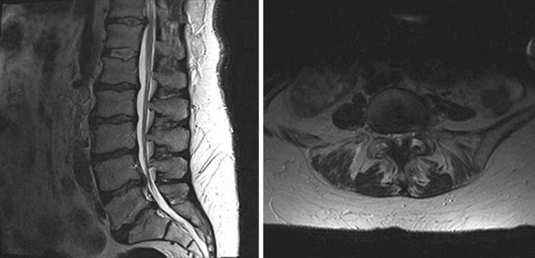 Figure 36.4, Severe lumbar spine degenerative changes. The sagittal view displays multilevel stenosis from anterior and posterior pathology as well as loss of intervertebral disk height. Axial views show facet hypertrophy with edema in the facet joints indicated by the hyperintensity.