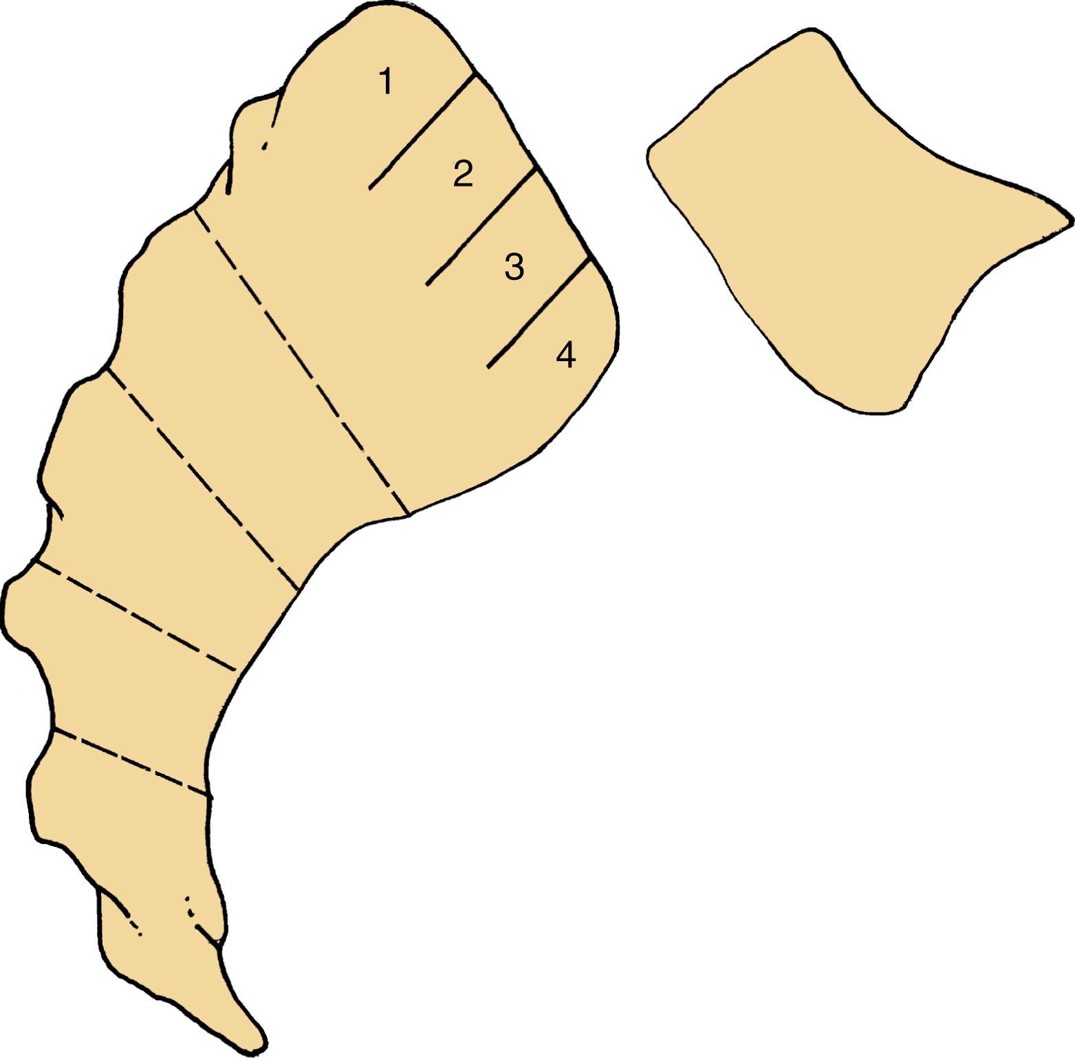 Fig. 139.1, The Meyerding classification of lumbar spondylolisthesis.