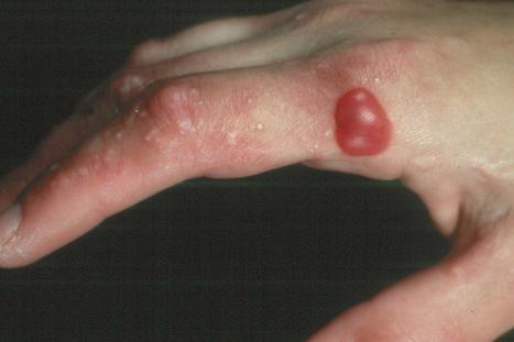 Fig. 13.101, Porphyria cutanea tarda: in addition to a blood-filled vesicle there are numerous milia.