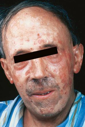 Fig. 13.104, Porphyria cutanea tarda: there is marked facial scarring with sclerodermiform features.