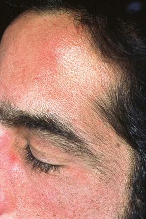 Fig. 13.105, Porphyria cutanea tarda: hypertrichosis as seen in this patient is a very typical feature.