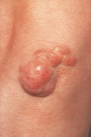 Fig. 13.11, Tuberous xanthoma: firm erythematous nodules over the elbow.