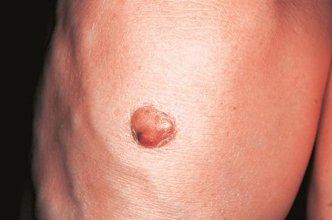 Fig. 13.12, Tuberous xanthoma: erythematous nodule on the back of the arm.