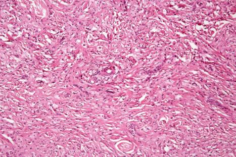 Fig. 13.16, Tuberous xanthoma: there is marked scarring.