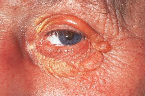 Fig. 13.18, Xanthelasmata: note the yellow, periorbital plaques. These are a common manifestation of hypercholesterolemia. By courtesy of the Institute of Dermatology, London, UK.