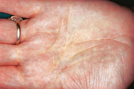 Fig. 13.20, Planar xanthoma: palmar lesions presenting as discrete macules with accentuation in the skin creases.