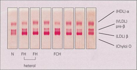 Fig. 13.2, Hyperlipidemia: electrophoretic separation of serum lipids. (Chylo, chylomicron; HDL, high density lipoprotein; LDL, low density lipoprotein; VLDL, very low density lipoprotein.)