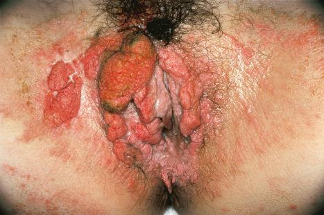 Fig. 13.24, Verruciform xanthoma: in this unusual gross example, there are numerous warty and polypoid lesions showing extensive involvement of the vulva, perineum, and thighs. A viral etiology was initially suspected clinically.