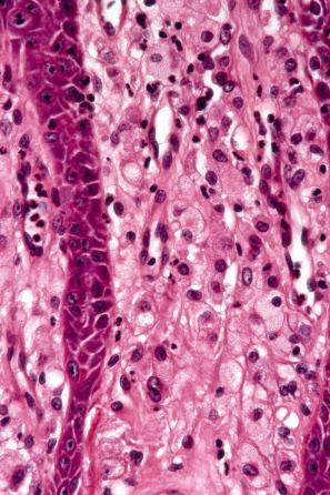 Fig. 13.27, Verruciform xanthoma: in the papillary dermis there is an infiltrate of uniform xanthoma cells.