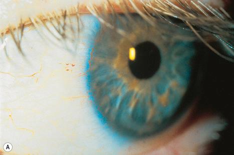 Fig. 13.30, Angiokeratoma corporis diffusum: ( A ) tortuous conjunctival vessels; ( B ) tortuous retinal vessels.